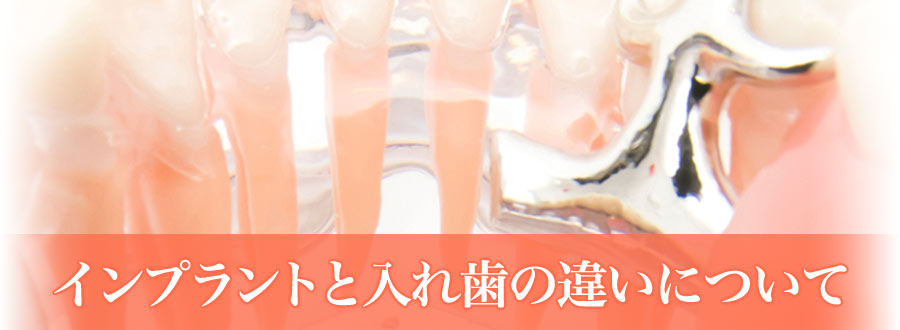 インプラントと入れ歯の違いについて